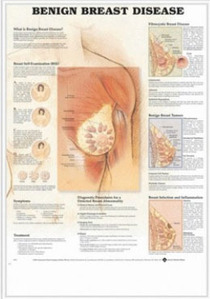 3D해부도(벽걸이)/ 9759 /여성가슴질환 ( BENIGN BREAST DISEASE )/ 54cm ⅹ 74cm