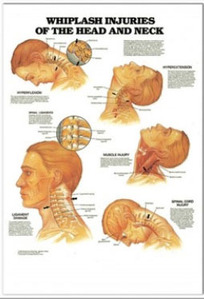 3D해부도(벽걸이)/ 9989/머리와 목의 반복성 긴장장애차트(WHIPLASH INJURIES OF THE HEAD AND NECK)/ 47cm ⅹ 65cm