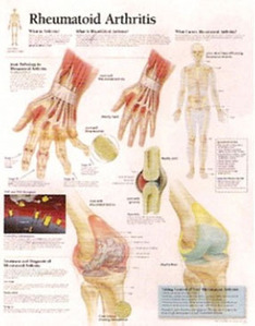 평면해부도(벽걸이)/ 1152 /류마티스관절염 Rheumatoid Arthritis