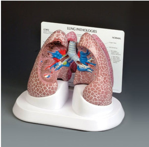 [GPI] 폐질환모형/G311/ Diseased Lung 311/폐모형,허파모형