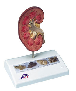 [3B] 신장결석모형 K29(14x10x16.5cm/0.3kg) ▶ Kidney Stone Model