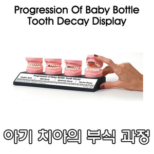 [인체모형] 아기 치아의 부식 과정 모형 79212