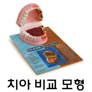 [SY] 치아비교모형 79650/건강한 치아와 손상된 치아 비교 모형