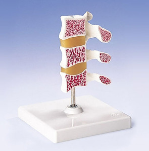 [3B] 골다공모형(A78)/ Deluxe Osteoporosis Model